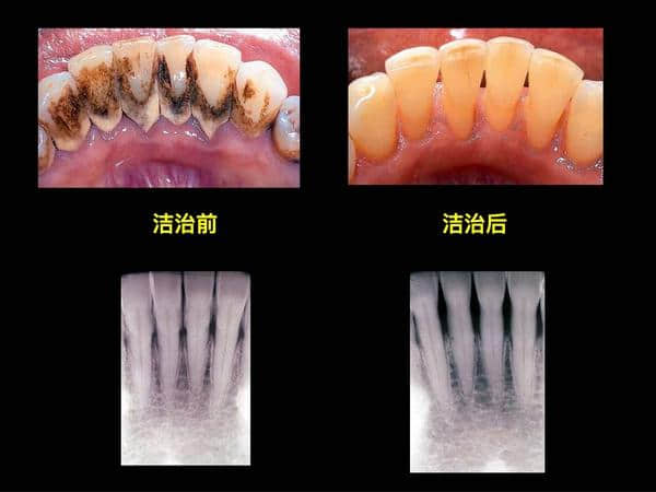 牙线会变大牙缝？洗牙会伤害牙龈？我们应该如何保护口腔卫生